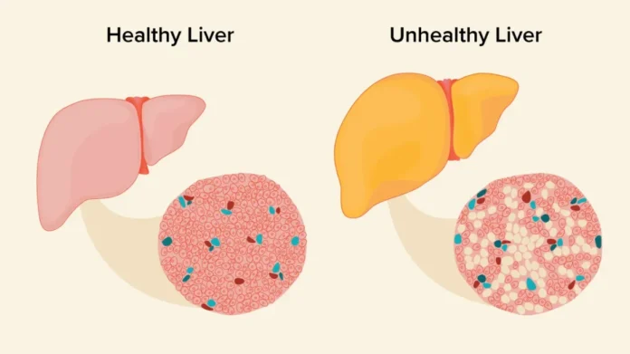 Fatty Liver Without Alcohol